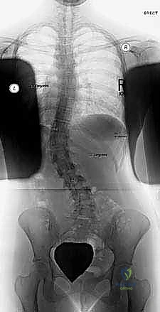 تشريح العمود الفقري وتأثير الجنف