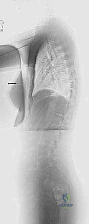 الدمج الفقري الأمامي مع التثبيت الجراحي للجنف: دليل شامل للمرضى مع الأستاذ الدكتور محمد هطيف