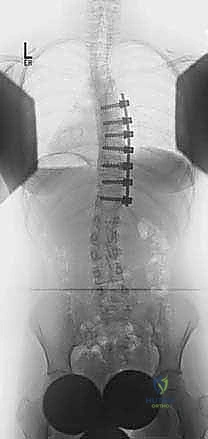 الجنف مجهول السبب عند المراهقين