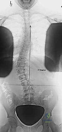 الجنف العصبي العضلي وتأثيره
