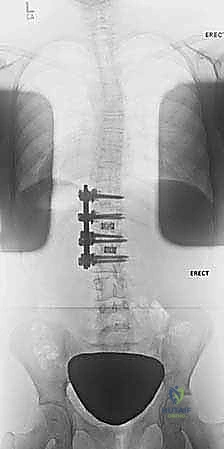 المضاعفات التنفسية الناتجة عن الجنف الشديد