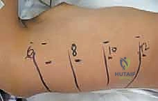 قياس زاوية كوب في الأشعة السينية