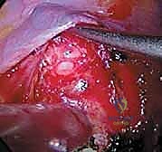 صورة طبية: الدمج الفقري الأمامي مع التثبيت الجراحي للجنف: دليل شامل للمرضى مع الأستاذ الدكتور محمد هطيف
