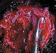 التحضير الطبي الشامل قبل جراحة الجنف