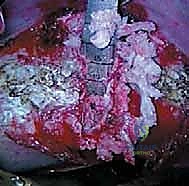 صورة توضيحية لـ الدمج الفقري الأمامي مع التثبيت الجراحي للجنف: دليل شامل للمرضى مع الأستاذ الدكتور محمد هطيف