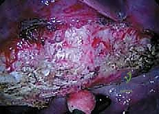 صورة توضيحية لـ الدمج الفقري الأمامي مع التثبيت الجراحي للجنف: دليل شامل للمرضى مع الأستاذ الدكتور محمد هطيف