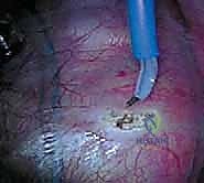 وضعية المريض أثناء التخدير للجراحة الأمامية