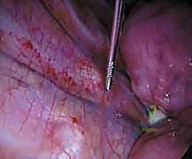 خيارات علاج الجنف بين التحفظي والجراحي