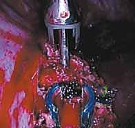 صورة طبية: الدمج الفقري الأمامي مع التثبيت الجراحي للجنف: دليل شامل للمرضى مع الأستاذ الدكتور محمد هطيف