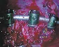 صورة طبية: الدمج الفقري الأمامي مع التثبيت الجراحي للجنف: دليل شامل للمرضى مع الأستاذ الدكتور محمد هطيف