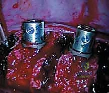 صورة طبية: الدمج الفقري الأمامي مع التثبيت الجراحي للجنف: دليل شامل للمرضى مع الأستاذ الدكتور محمد هطيف