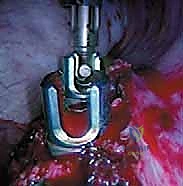 صورة طبية: الدمج الفقري الأمامي مع التثبيت الجراحي للجنف: دليل شامل للمرضى مع الأستاذ الدكتور محمد هطيف