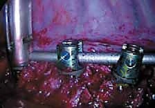 صورة توضيحية لـ الدمج الفقري الأمامي مع التثبيت الجراحي للجنف: دليل شامل للمرضى مع الأستاذ الدكتور محمد هطيف