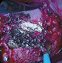 صورة توضيحية لـ الدمج الفقري الأمامي مع التثبيت الجراحي للجنف: دليل شامل للمرضى مع الأستاذ الدكتور محمد هطيف