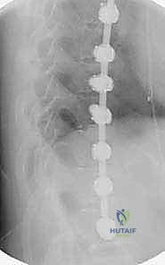 صورة توضيحية لـ الدمج الفقري الأمامي مع التثبيت الجراحي للجنف: دليل شامل للمرضى مع الأستاذ الدكتور محمد هطيف