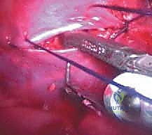 صورة طبية: الدمج الفقري الأمامي مع التثبيت الجراحي للجنف: دليل شامل للمرضى مع الأستاذ الدكتور محمد هطيف