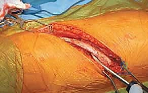 صورة طبية: الدمج الفقري الأمامي مع التثبيت الجراحي للجنف: دليل شامل للمرضى مع الأستاذ الدكتور محمد هطيف