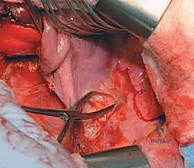 صورة طبية: الدمج الفقري الأمامي مع التثبيت الجراحي للجنف: دليل شامل للمرضى مع الأستاذ الدكتور محمد هطيف