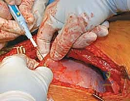 صورة طبية: الدمج الفقري الأمامي مع التثبيت الجراحي للجنف: دليل شامل للمرضى مع الأستاذ الدكتور محمد هطيف