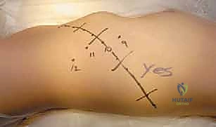 صورة طبية: الدمج الفقري الأمامي مع التثبيت الجراحي للجنف: دليل شامل للمرضى مع الأستاذ الدكتور محمد هطيف