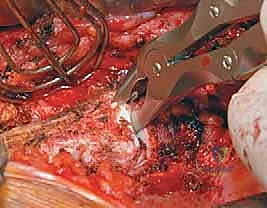 صورة توضيحية لـ الدمج الفقري الأمامي مع التثبيت الجراحي للجنف: دليل شامل للمرضى مع الأستاذ الدكتور محمد هطيف