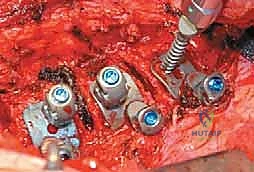 صورة طبية: الدمج الفقري الأمامي مع التثبيت الجراحي للجنف: دليل شامل للمرضى مع الأستاذ الدكتور محمد هطيف