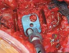 استخدام أجهزة المراقبة العصبية أثناء الجراحة