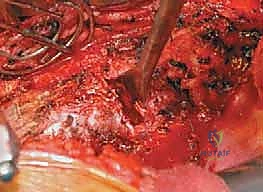 صورة طبية: الدمج الفقري الأمامي مع التثبيت الجراحي للجنف: دليل شامل للمرضى مع الأستاذ الدكتور محمد هطيف