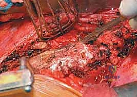 صورة طبية: الدمج الفقري الأمامي مع التثبيت الجراحي للجنف: دليل شامل للمرضى مع الأستاذ الدكتور محمد هطيف