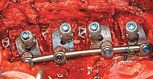 مفهوم الدمج الفقري الأمامي للجنف