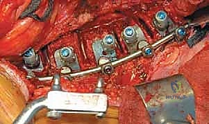 صورة طبية: الدمج الفقري الأمامي مع التثبيت الجراحي للجنف: دليل شامل للمرضى مع الأستاذ الدكتور محمد هطيف