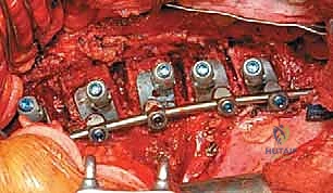 صورة طبية: الدمج الفقري الأمامي مع التثبيت الجراحي للجنف: دليل شامل للمرضى مع الأستاذ الدكتور محمد هطيف