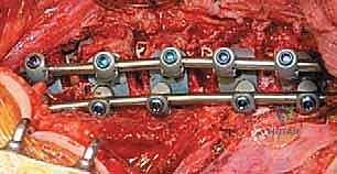 صورة طبية: الدمج الفقري الأمامي مع التثبيت الجراحي للجنف: دليل شامل للمرضى مع الأستاذ الدكتور محمد هطيف