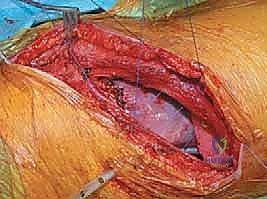 صورة طبية: الدمج الفقري الأمامي مع التثبيت الجراحي للجنف: دليل شامل للمرضى مع الأستاذ الدكتور محمد هطيف