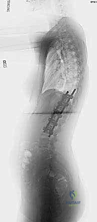 Illustration of anterior interbody arthrodesis - Dr. Mohammed Hutaif