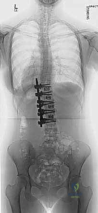 صورة طبية: الدمج الفقري الأمامي مع التثبيت الجراحي للجنف: دليل شامل للمرضى مع الأستاذ الدكتور محمد هطيف