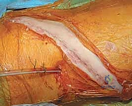 صورة طبية: الدمج الفقري الأمامي مع التثبيت الجراحي للجنف: دليل شامل للمرضى مع الأستاذ الدكتور محمد هطيف