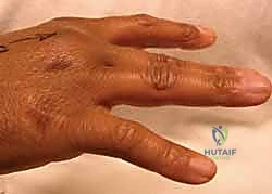 استخدام الجبائر في العلاج التحفظي