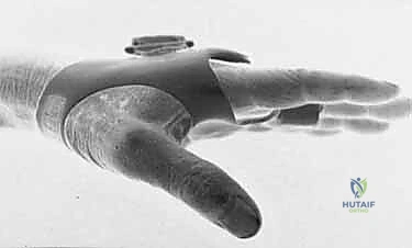 صورة توضيحية لـ خلع وتر الباسطة في اليد