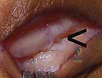 التخطيط الجراحي لترميم الرباط السهمي