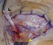 صورة توضيحية لـ خلع وتر الباسطة في اليد: دليل شامل لإصلاح وإعادة بناء الرباط السهمي مع الأستاذ الدكتور محمد هطيف