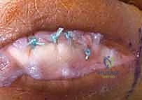 الإصلاح الجراحي المباشر للرباط