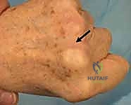 صورة توضيحية لـ خلع وتر الباسطة في اليد: دليل شامل لإصلاح وإعادة بناء الرباط السهمي مع الأستاذ الدكتور محمد هطيف