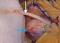 صورة توضيحية لـ خلع وتر الباسطة في اليد: دليل شامل لإصلاح وإعادة بناء الرباط السهمي مع الأستاذ الدكتور محمد هطيف