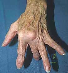 صورة توضيحية لـ خلع وتر الباسطة في اليد: دليل شامل لإصلاح وإعادة بناء الرباط السهمي مع الأستاذ الدكتور محمد هطيف