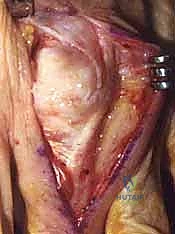 صورة توضيحية لـ خلع وتر الباسطة في اليد: دليل شامل لإصلاح وإعادة بناء الرباط السهمي مع الأستاذ الدكتور محمد هطيف