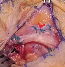 صورة توضيحية لـ خلع وتر الباسطة في اليد: دليل شامل لإصلاح وإعادة بناء الرباط السهمي مع الأستاذ الدكتور محمد هطيف