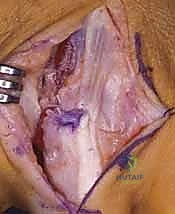 Intraoperative Surgical Step