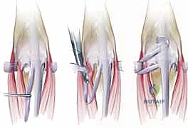 صورة طبية: خلع وتر الباسطة في اليد: دليل شامل لإصلاح وإعادة بناء الرباط السهمي مع الأستاذ الدكتور محمد هطيف