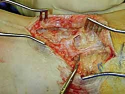 صورة توضيحية لـ ورم العصب في القدم والكاحل: دليل شامل وخبرة الأستاذ الدكتور محمد هطيف في صنعاء